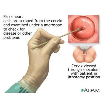 Link to /sites/default/files/styles/card/public/images/blog/thumb/cervical-cancer-pap-test-752185.jpg?h=af5c1e63&itok=aBs4Tnnf