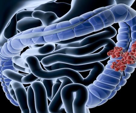 A digital representation of the lower GI track, with one section of it covered with clusters of red cells.