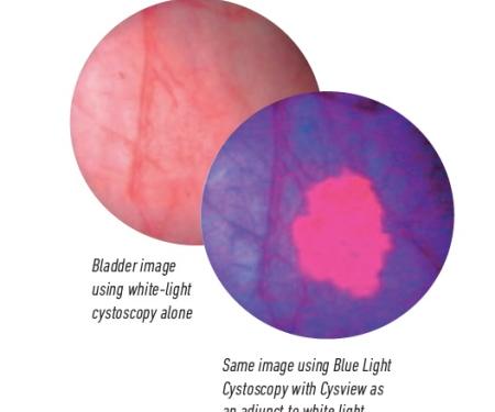 A side by side comparison of a bladder cystoscopy image with white light alone, and one using blue light with Cysview to assist.