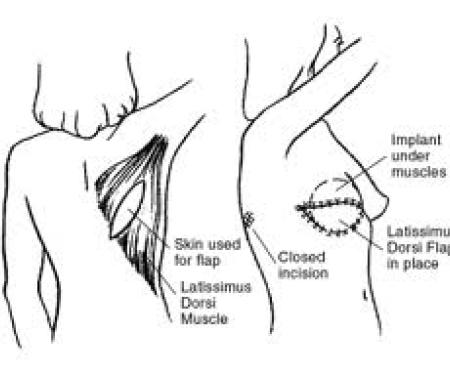 A diagram showing the skin from back muscle taken for a breast reconstruction, and where it would be attached in front.