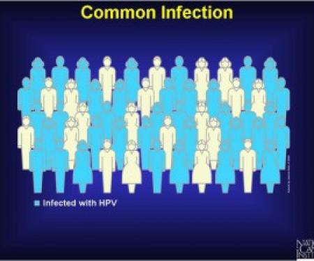 Link to /sites/default/files/styles/post_teaser_image_300x250_/public/images/blog/thumb/HPV_Infection-300x225.jpg?h=73541a1f&itok=c1pT_IJk