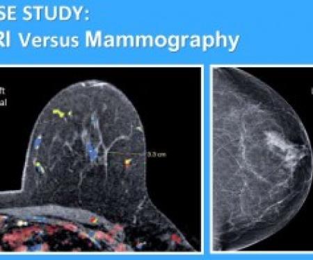 A side-by-side comparison of an MRI and a mammogram of a breast.