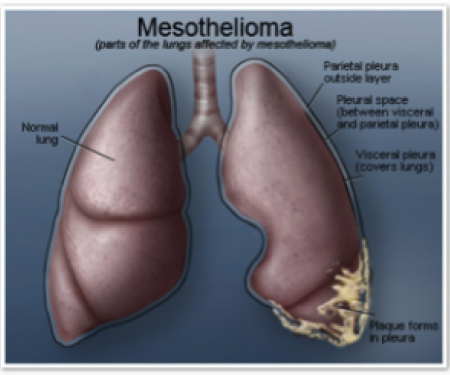 A drawing of a set of human lungs with the bottom right side covered in webs of plaque, depicting mesothelioma.