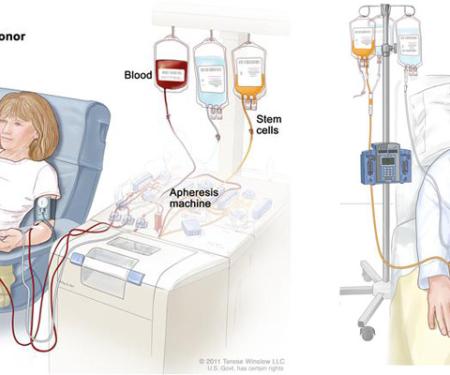 Link to /sites/default/files/styles/post_teaser_image_300x250_/public/images/blog/thumb/StemCellTransplant.jpg?h=65ec6869&itok=UOfWiqWS