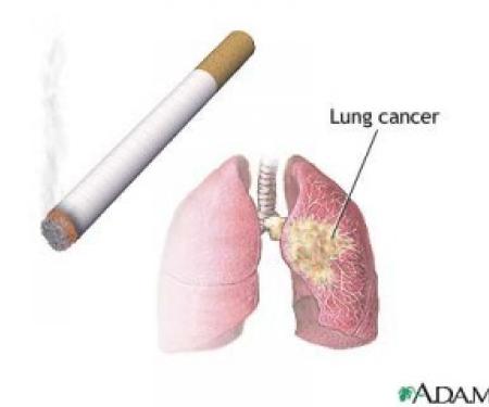 A drawing of a pair of lungs with a tan splotch on it labelled as lung cancer, and a lit cigarette drawn next to it.