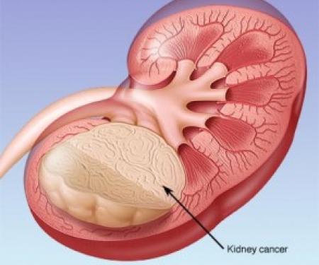 Link to /sites/default/files/styles/post_teaser_image_300x250_/public/images/blog/thumb/mayo_kidney_cancer-293x300.jpg?h=a7377bda&itok=rfmOje8t