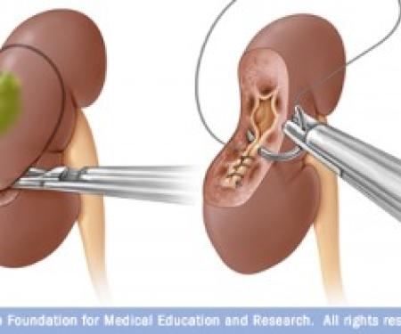 Link to /sites/default/files/styles/post_teaser_image_300x250_/public/images/blog/thumb/partial_nephrectomy-300x197.jpg?h=b02b37cb&itok=N6IDellg