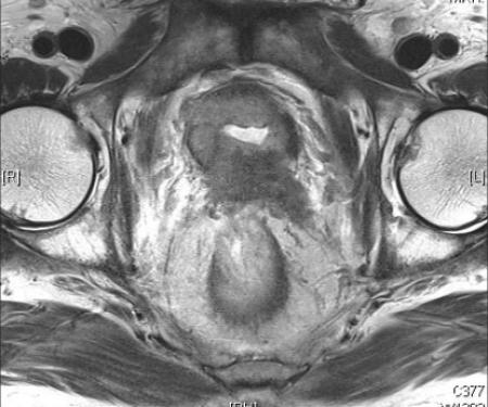 A black and white MRI photo of a malignant lesion of the prostate, from the National Institutes of Health.