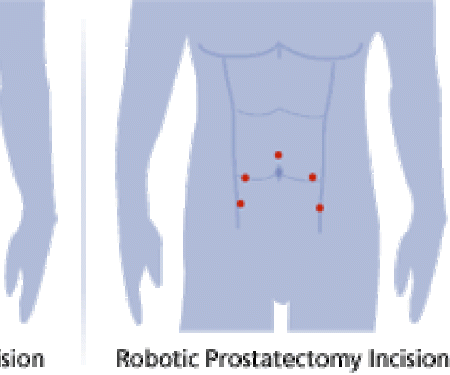 A diagram showing the incision difference between an open and robotic prostatectomy, with the open one being much larger.