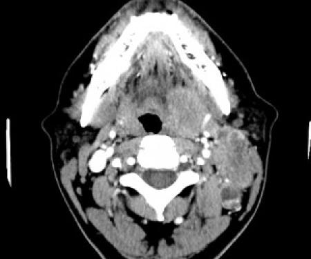 Link to /sites/default/files/styles/post_teaser_image_300x250_/public/images/blog/thumb/tonsil-and-neck-300x300.jpg?h=6c83441f&itok=QOb0ehoT