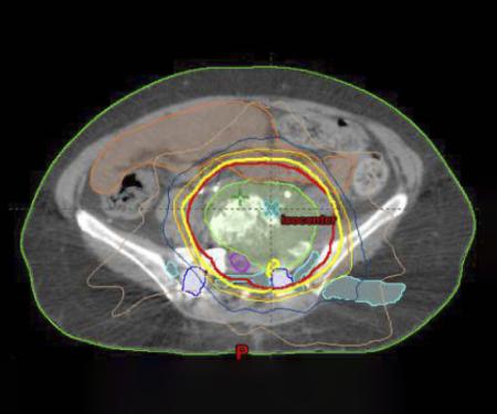 Link to /sites/default/files/styles/post_teaser_image_300x250_/public/images/news/thumb/Meyer%20Pelvic%20Reirradiation%201024_1%20square.jpg?h=ef6a3dfa&itok=ldKtF9bX
