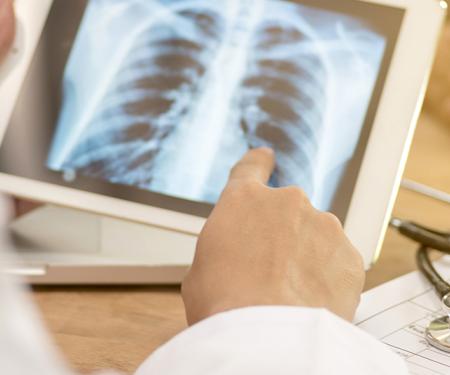 A closeup photograph of a medical professional examining an x-ray of a patient's chest on a tablet.