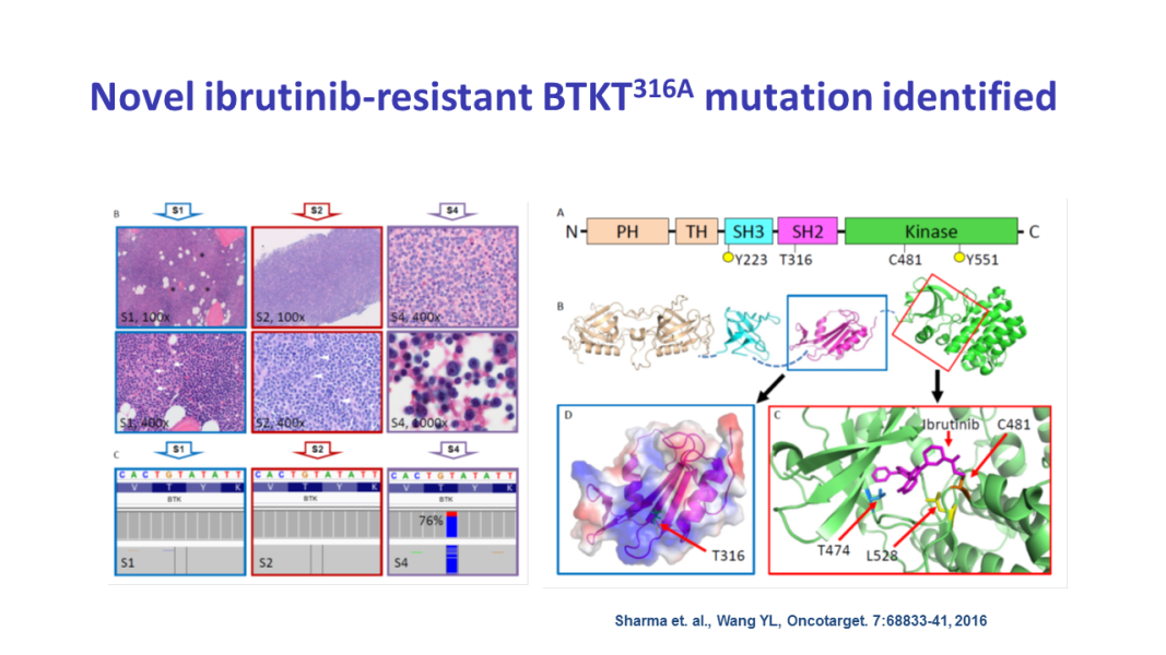 Novel ibrutinib-resistant BTKT316A mutation identified