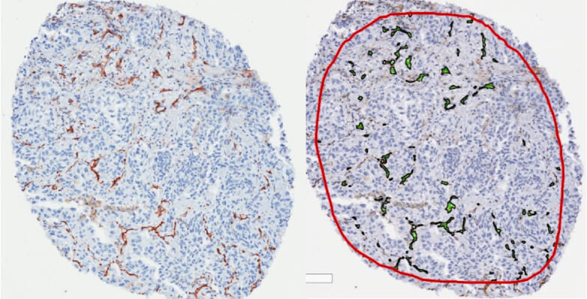 Link to /sites/default/files/styles/slider_desktop/public/images/slide/microvessel-density-count.jpg?itok=WNSMUDl3