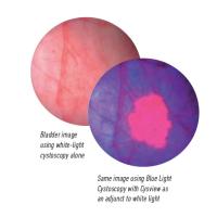 A side by side comparison of a bladder cystoscopy image with white light alone, and one using blue light with Cysview to assist.