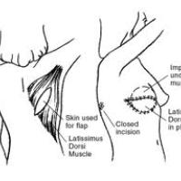 A diagram showing the skin from back muscle taken for a breast reconstruction, and where it would be attached in front.