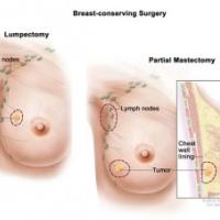 A side by side diagram comparison of two breast conserving surgeries: a lumpectomy and a partial mastectomy.