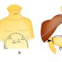 A diagram showing the steps associated with an esophagectomy.