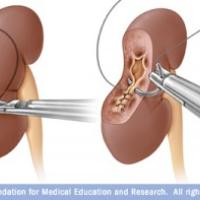 Link to /sites/default/files/styles/thumb/public/images/blog/thumb/partial_nephrectomy-300x197.jpg?h=b02b37cb&itok=ZEq2F_Hc